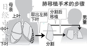 日本成功實(shí)施全球較精細(xì)活體肺移植手術(shù)（圖）