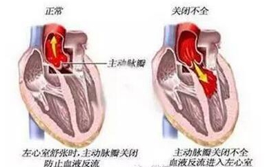 日本心臟瓣膜手術(shù)