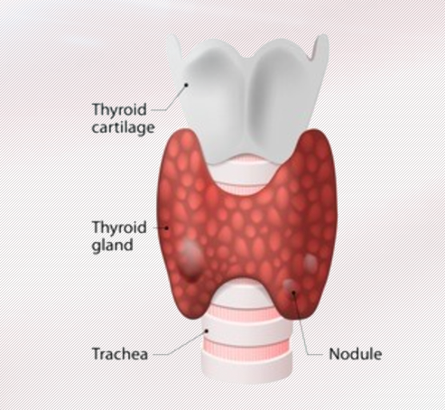 美國治療甲狀腺腫瘤