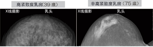 乳腺癌如何檢查？日本開發(fā)出一種新技能可用于早期檢測(cè)乳腺癌