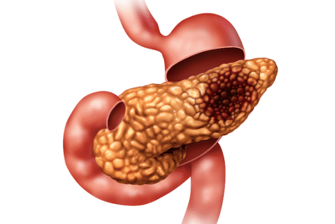 胰腺癌為什么難以治療？