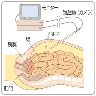 日本早期結(jié)直腸癌治療