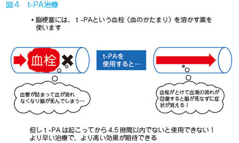 日本紅十字會(huì)總醫(yī)院治療腦梗塞的方法