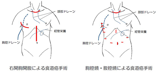 食道癌手術治療