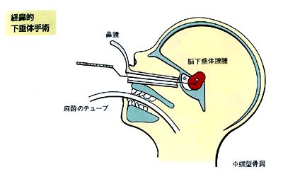 女性腦垂體瘤手術治療方法