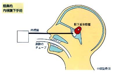 早期腦垂體瘤手術(shù)治療