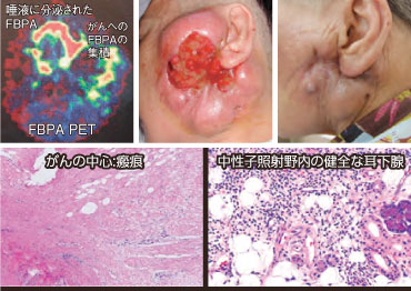 硼中子俘獲治療方法