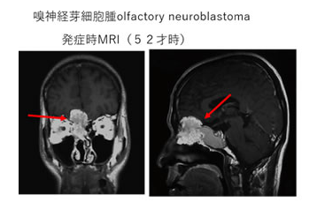 嗅神經(jīng)母細胞瘤