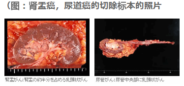 腎盂輸尿管癌