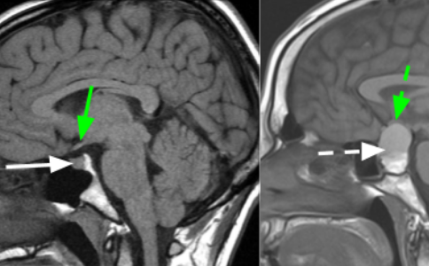 美國治療垂體瘤