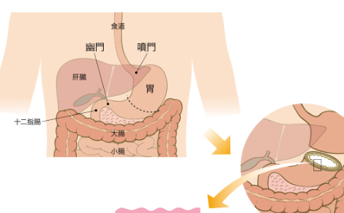 日本胃癌藥物治療