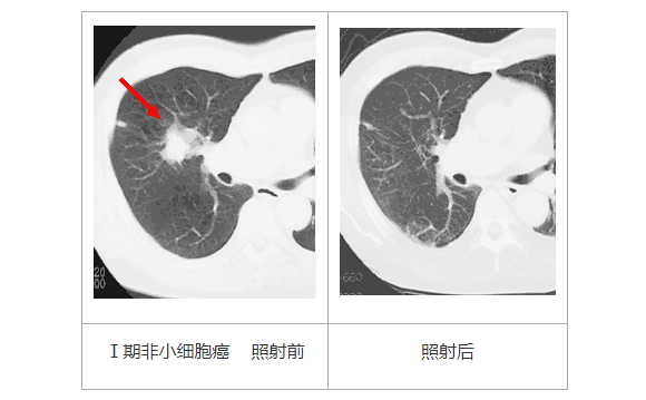 日本肺癌治療