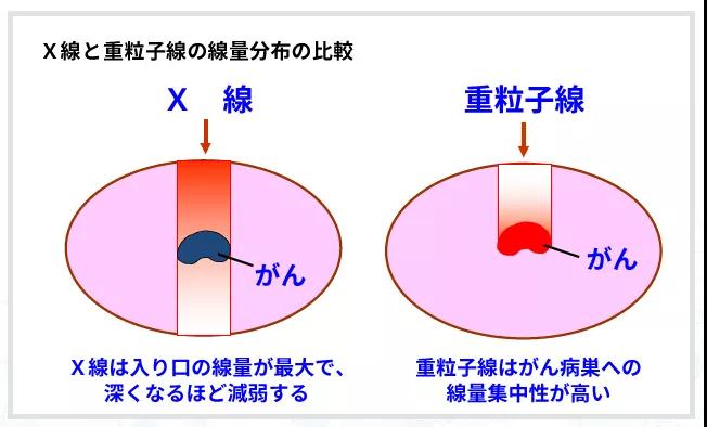 重離子治療前列腺癌