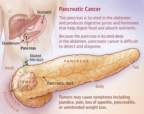 胰腺癌癥狀