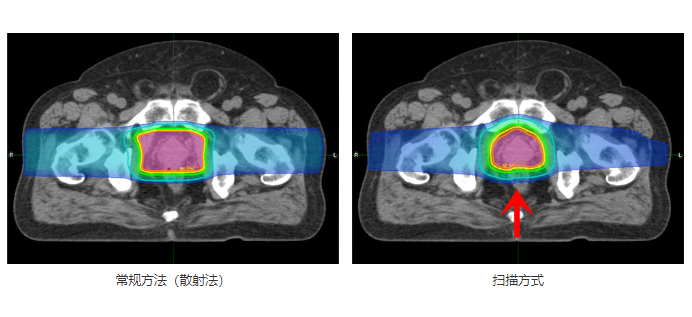 質(zhì)子治療前列腺癌的劑量分布