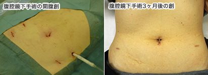 大腸癌腹腔鏡手術