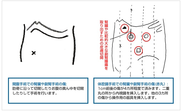 腎癌腹腔鏡手術(shù)