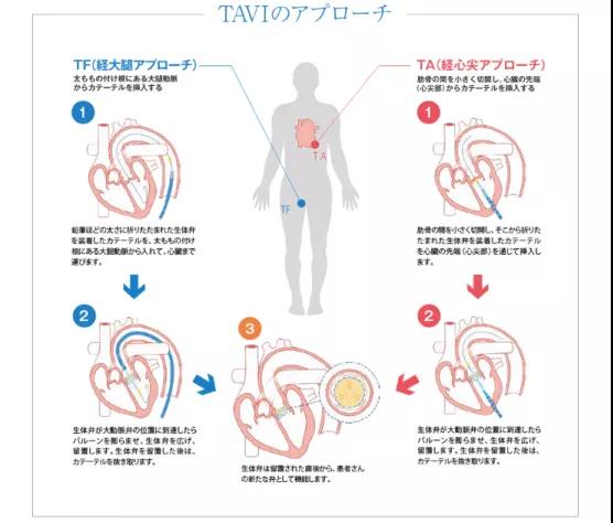 心臟瓣膜疾病