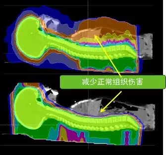 質子治療