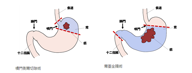 日本胃癌治療醫(yī)院