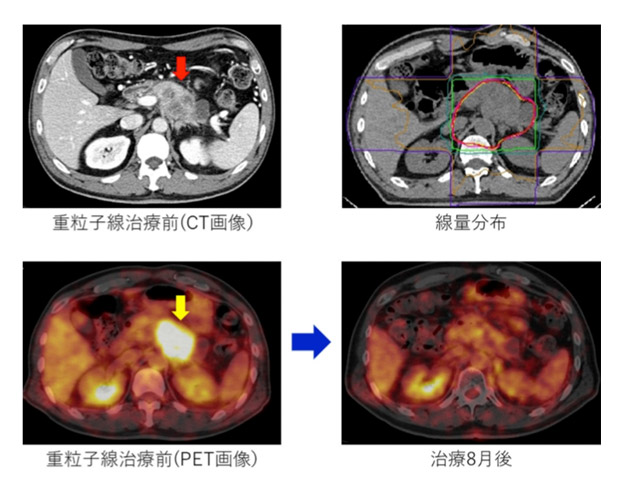 質子重離子治療胰腺癌