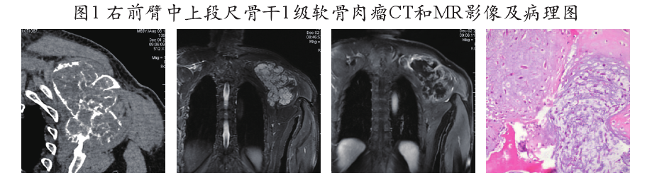 軟骨肉瘤治療