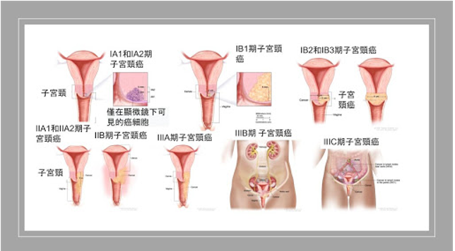 宮頸癌