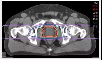 重離子治療前列腺癌效果