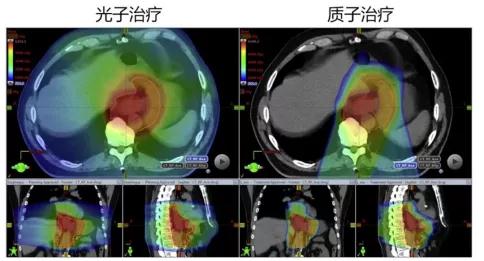 質(zhì)子重離子治療食管癌