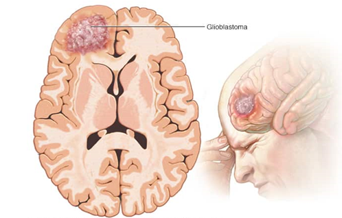 腦膠質(zhì)瘤