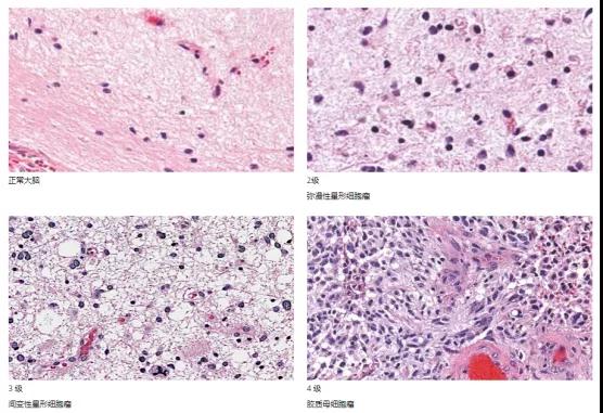 星形細(xì)胞瘤分級(jí)