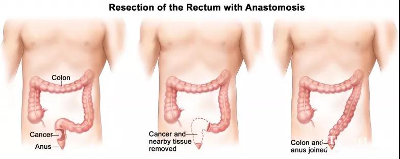 直腸癌保肛手術(shù)