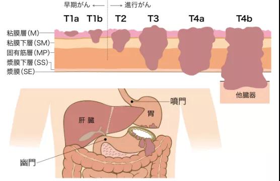 日本治療胃癌