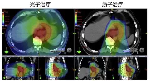 質(zhì)子治療食管癌