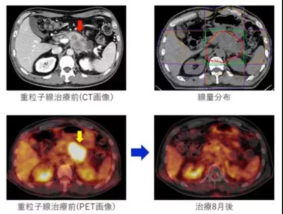 胰腺癌質(zhì)子重離子治療