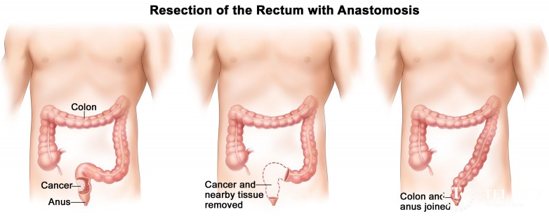結(jié)腸癌直腸癌手術(shù)治療