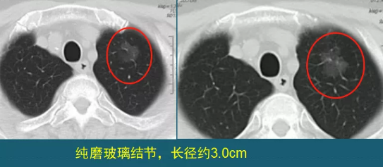 肺磨玻璃結(jié)節(jié) 肺癌